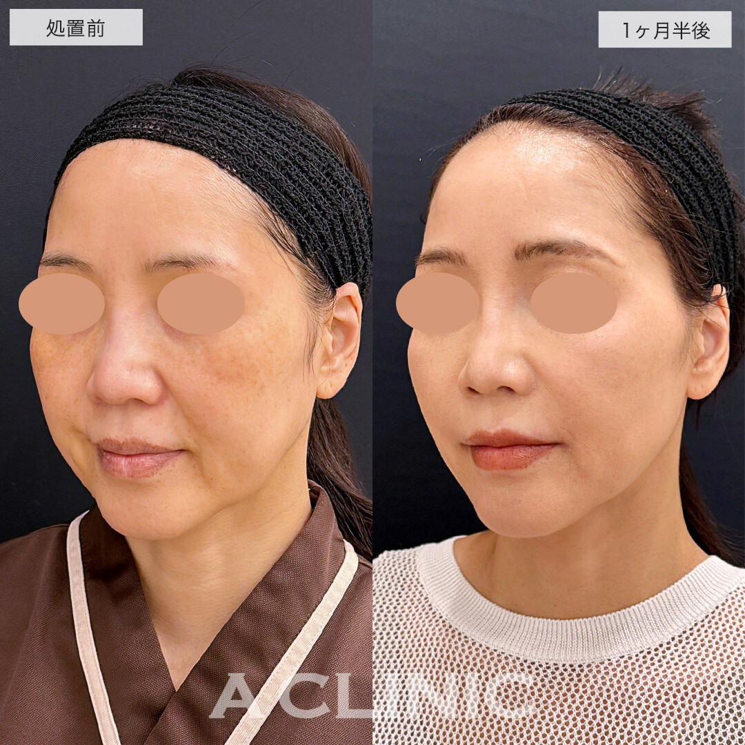 1day小顔脂肪吸引とバッカルファット除去、ほうれい線へのヒアルロン酸注射でナチュラルに上品な若返りへ!処置前と1ヶ月半後の症例です(40代女性)