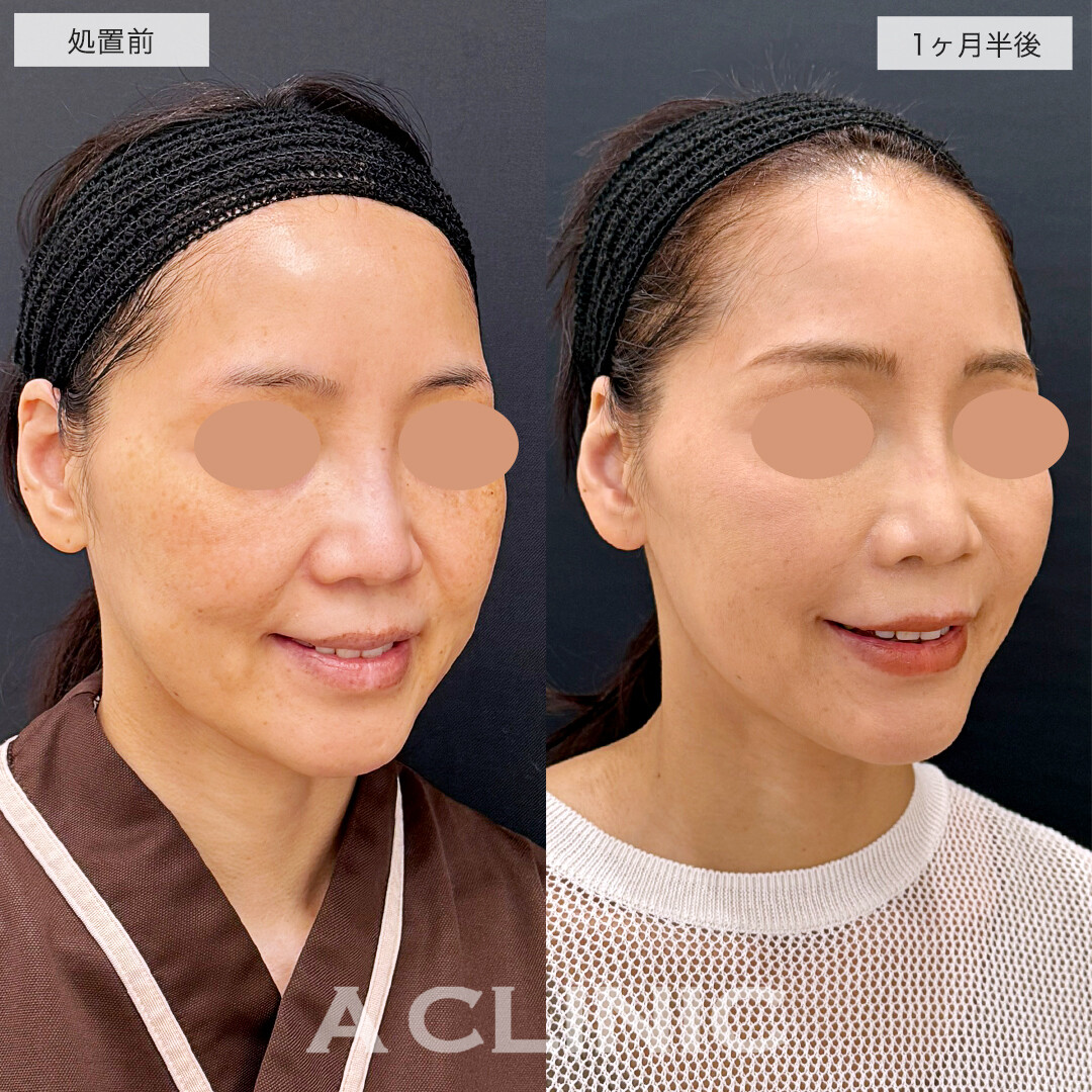 1day小顔脂肪吸引とバッカルファット除去、ほうれい線へのヒアルロン酸注射でナチュラルに上品な若返りへ!処置前と1ヶ月半後の症例です(40代女性)