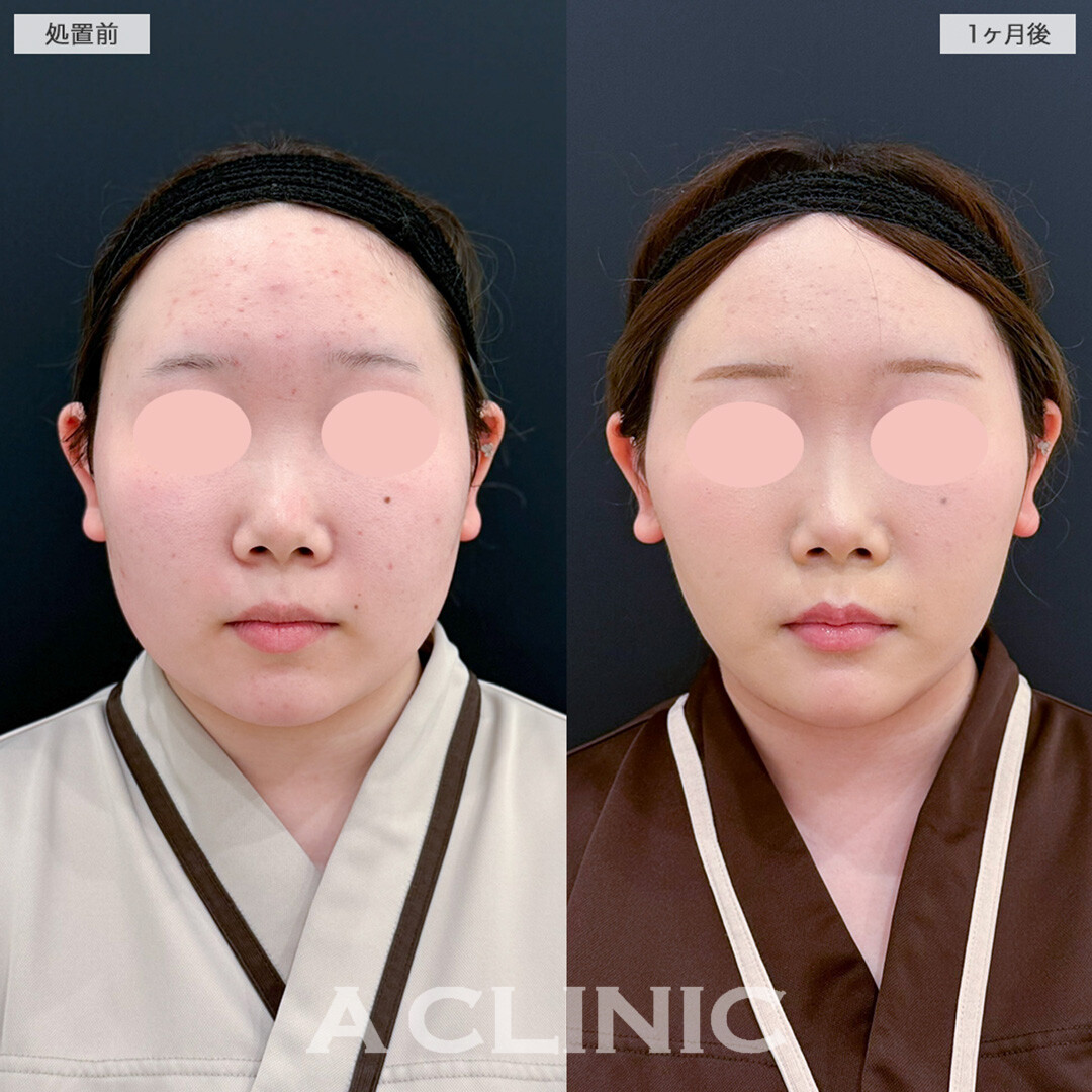 1day小顔脂肪吸引とボトックスとヒアルロン酸注入の組み合わせによって余白が一回り減りあごのシワも解消しました！こちら処置前と1ヶ月後の症例です(20代女性)