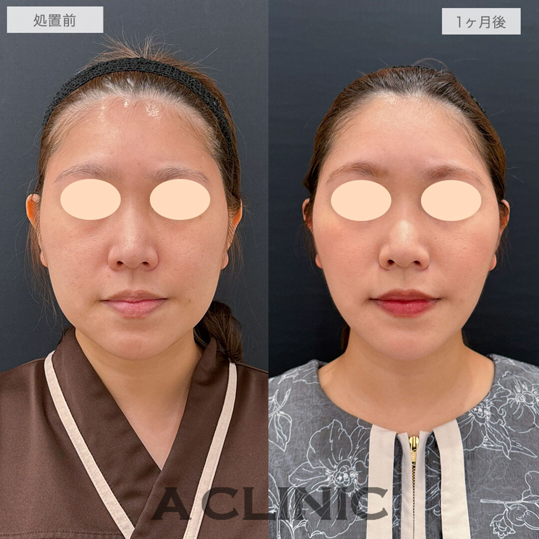 1day小顔脂肪吸引とバッカルファット除去術と小顔エラボトックスでお顔のボリューム感を改善！こちら処置前と1ヶ月後の症例です(30代女性)