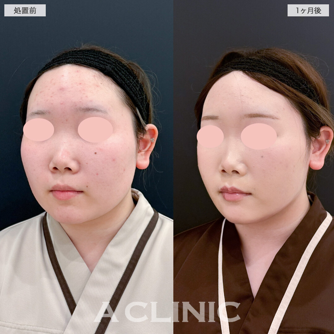 1day小顔脂肪吸引とボトックスとヒアルロン酸注入の組み合わせによって余白が一回り減りあごのシワも解消しました！こちら処置前と1ヶ月後の症例です(20代女性)