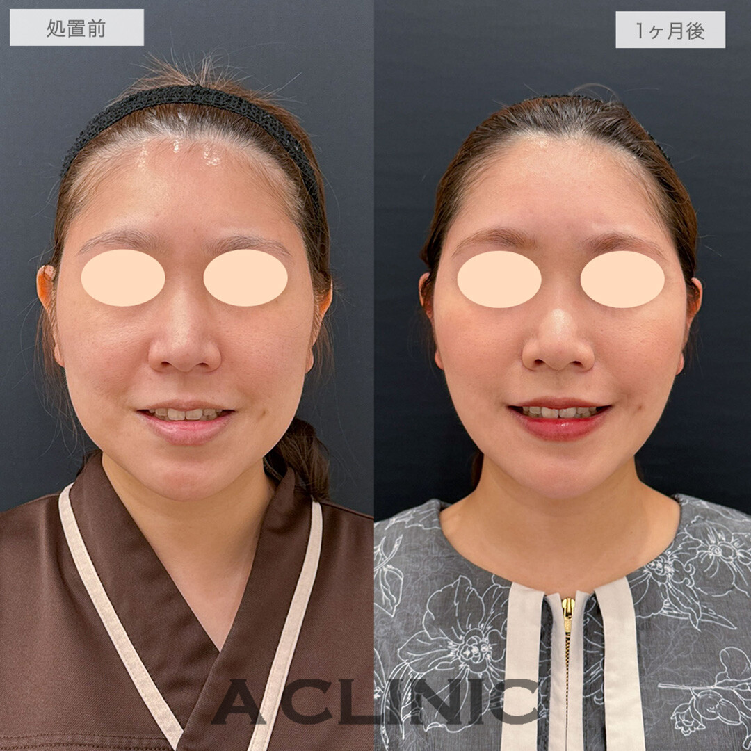 1day小顔脂肪吸引とバッカルファット除去術と小顔エラボトックスでお顔のボリューム感を改善！こちら処置前と1ヶ月後の症例です(30代女性)