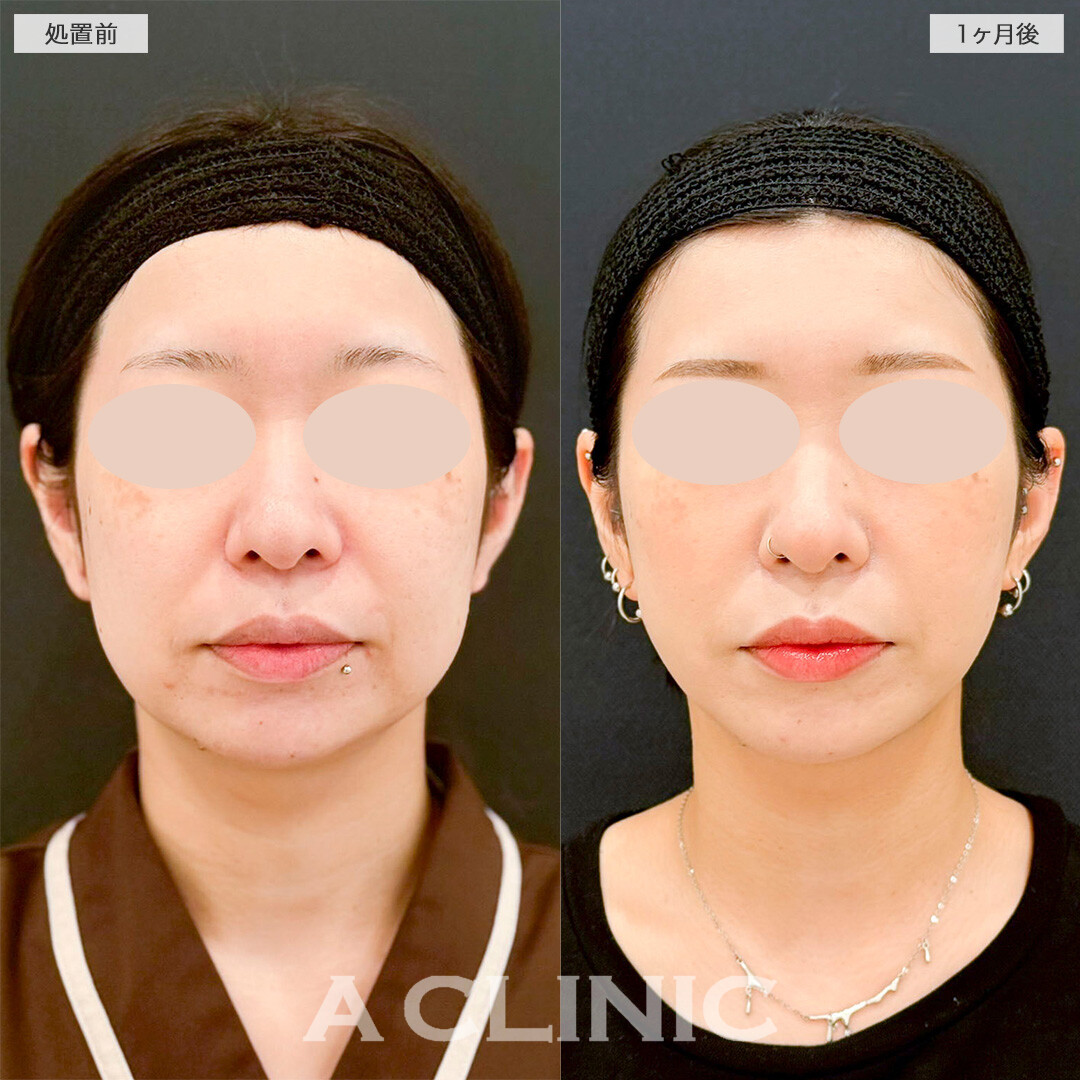 1day小顔脂肪吸引で四角い輪郭から理想のVフェイスに！処置前と1ヶ月後の症例です(30代女性)