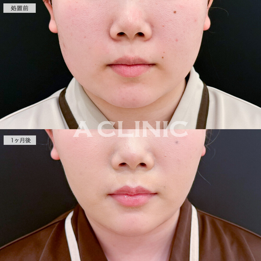 1day小顔脂肪吸引とボトックスとヒアルロン酸注入の組み合わせによって余白が一回り減りあごのシワも解消しました！こちら処置前と1ヶ月後の症例です(20代女性)