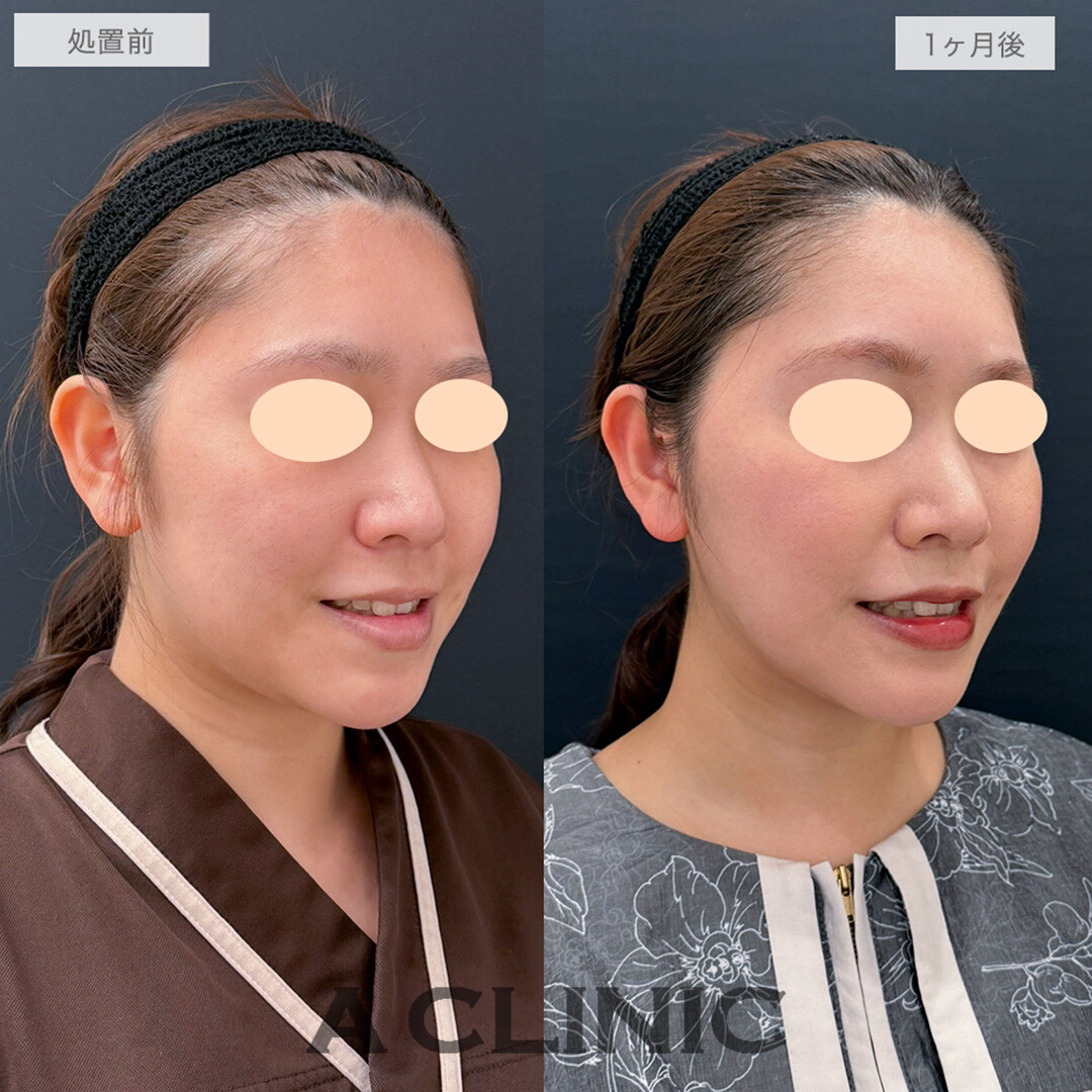 1day小顔脂肪吸引とバッカルファット除去術と小顔エラボトックスでお顔のボリューム感を改善！こちら処置前と1ヶ月後の症例です(30代女性)