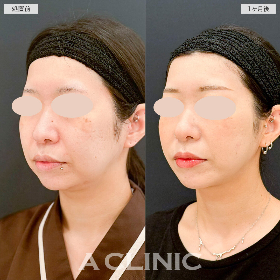 1day小顔脂肪吸引で四角い輪郭から理想のVフェイスに！処置前と1ヶ月後の症例です(30代女性)
