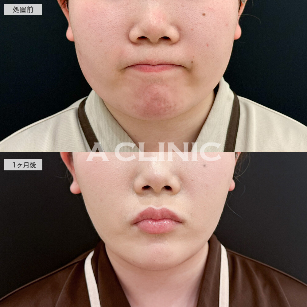 1day小顔脂肪吸引とボトックスとヒアルロン酸注入の組み合わせによって余白が一回り減りあごのシワも解消しました！こちら処置前と1ヶ月後の症例です(20代女性)