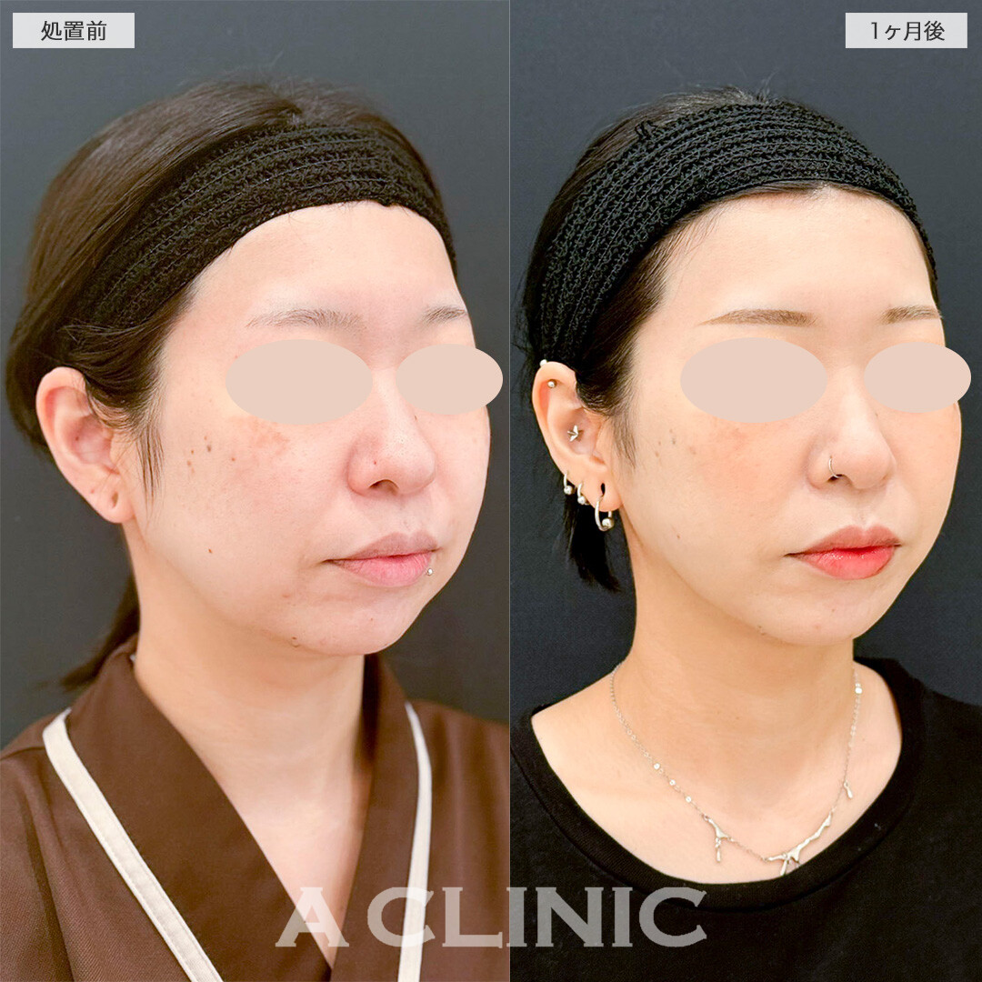 1day小顔脂肪吸引で四角い輪郭から理想のVフェイスに！処置前と1ヶ月後の症例です(30代女性)