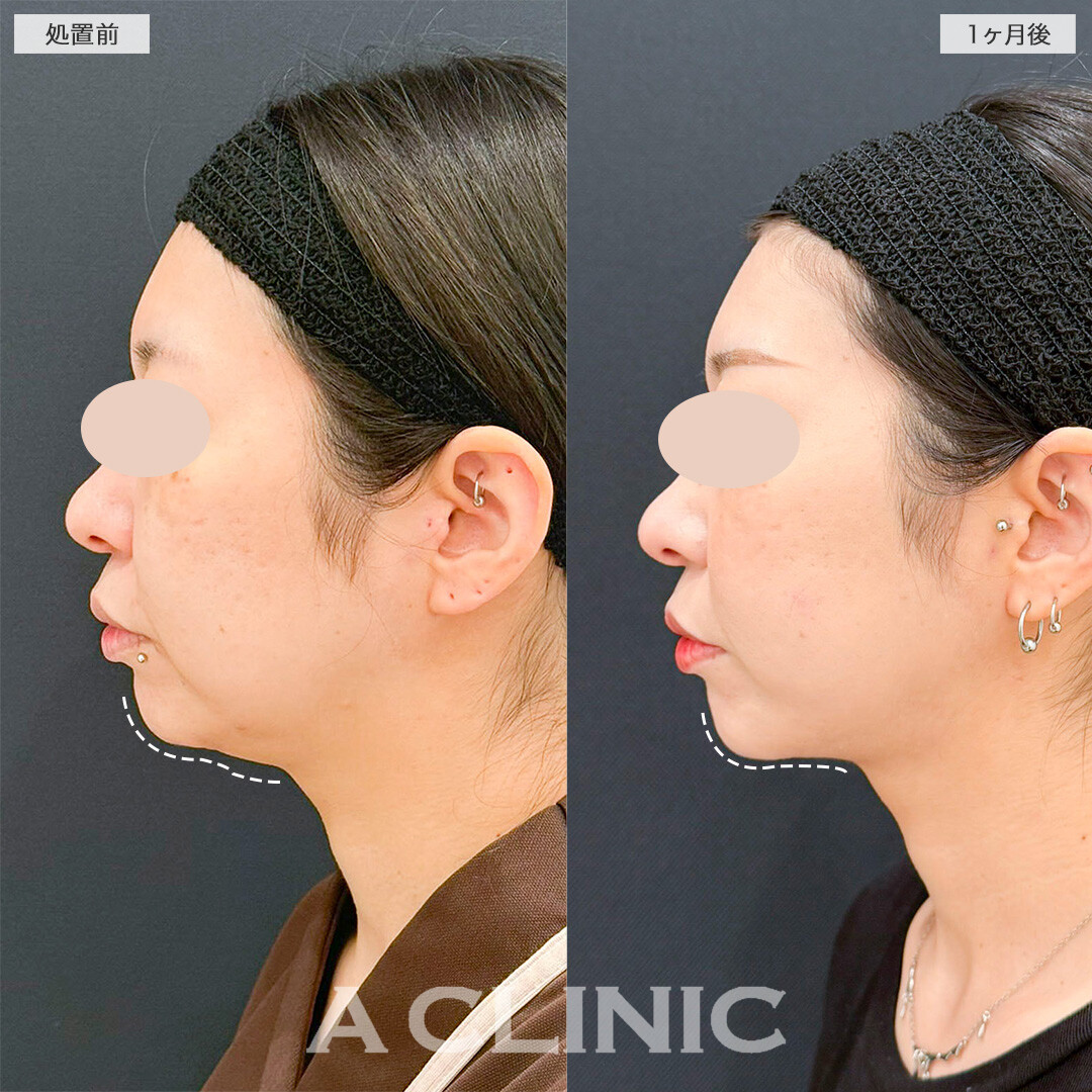 1day小顔脂肪吸引で四角い輪郭から理想のVフェイスに！処置前と1ヶ月後の症例です(30代女性)