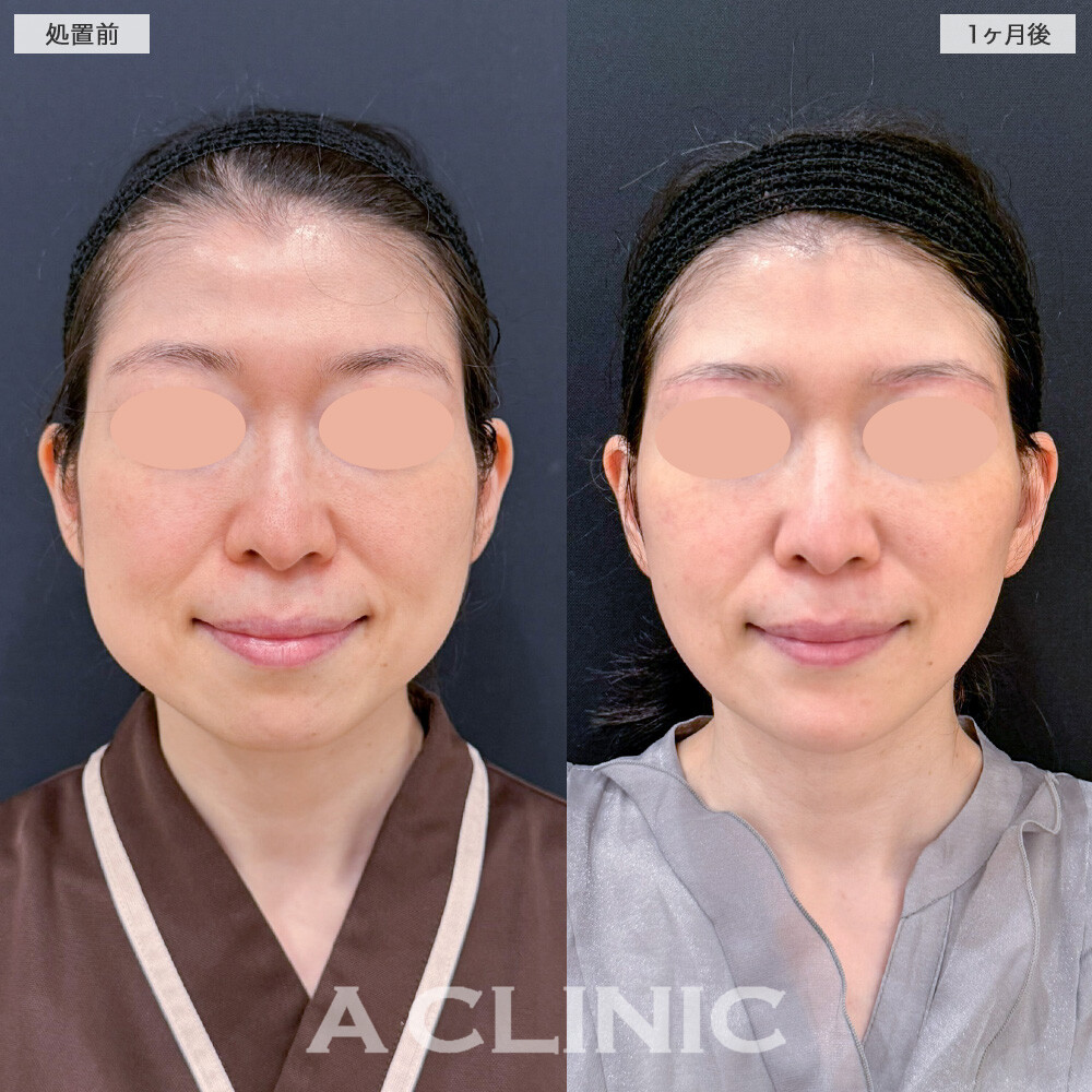 1day小顔脂肪吸引とA式美肌たるみ切開でフェイスラインのボリュームが無くなってスッキリ小顔に！こちら処置前と1ヶ月後の症例です(40代女性)