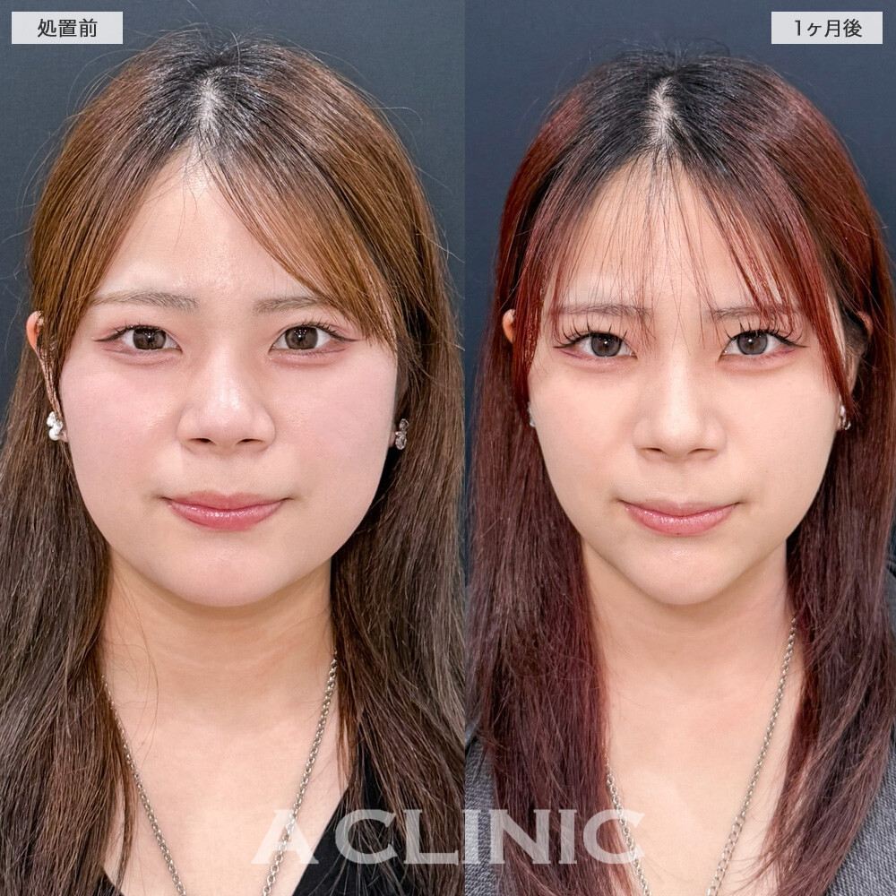 1day小顔脂肪吸引で抱えていた二重顎がスッキリ解消されました！こちら処置前と1ヶ月後の症例です(20代女性)