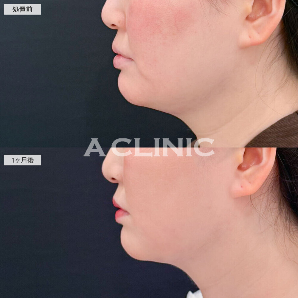 1day小顔脂肪吸引で脂肪ゼロのペラペラなあご下に!処置前から3ヶ月後の症例です(30代女性)