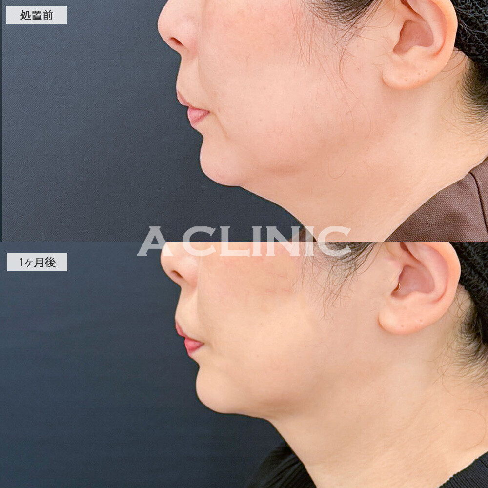 1day小顔脂肪吸引であご下の脂肪とたるみが無くなり若々しい印象になりました！処置前から2ヶ月後の症例です(50代女性)
