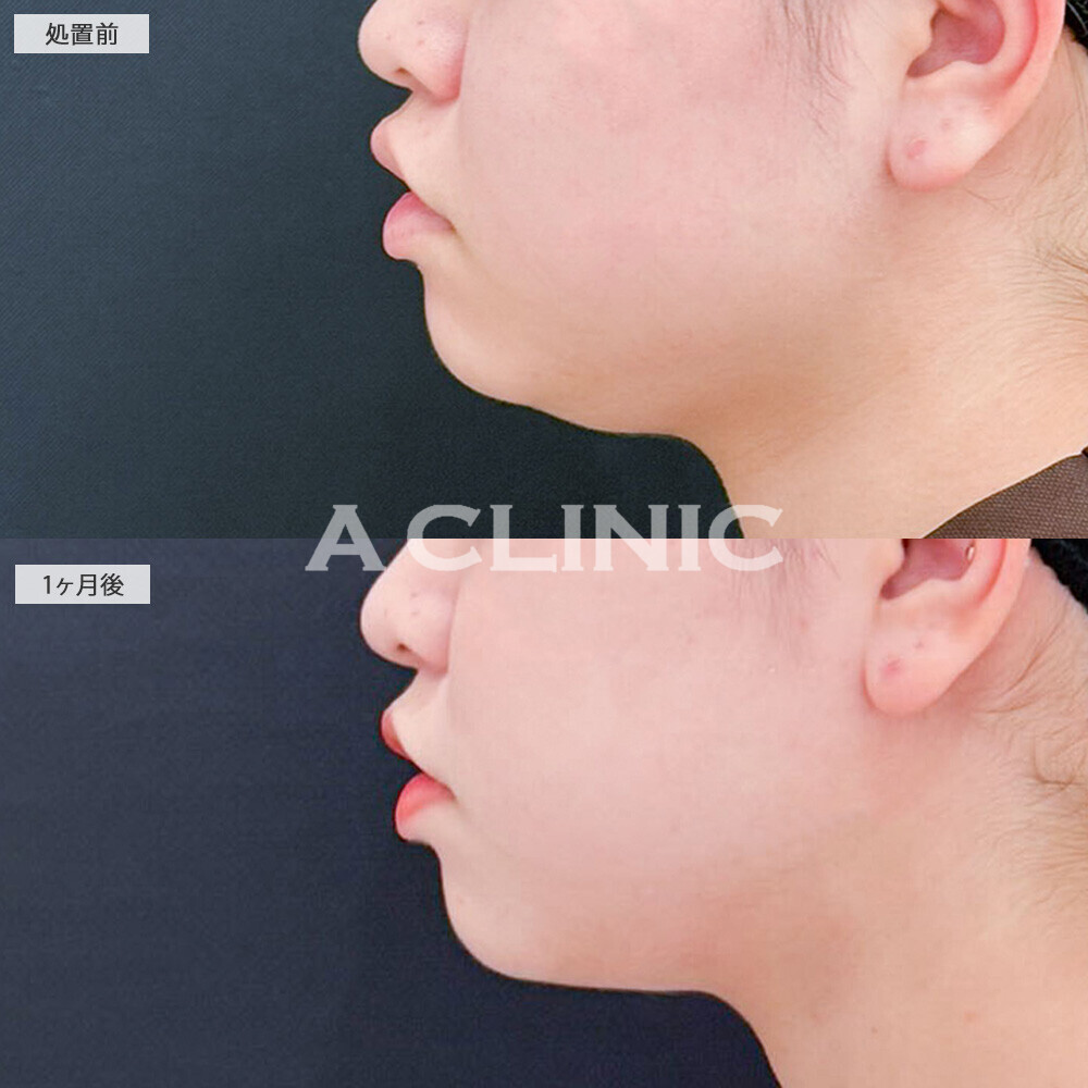 1day小顔脂肪吸引を受けると別人級の変化で垢抜け成功!処置前から2ヶ月後の症例です(10代女性)