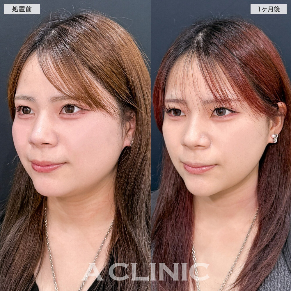 1day小顔脂肪吸引で抱えていた二重顎がスッキリ解消されました！こちら処置前と1ヶ月後の症例です(20代女性)