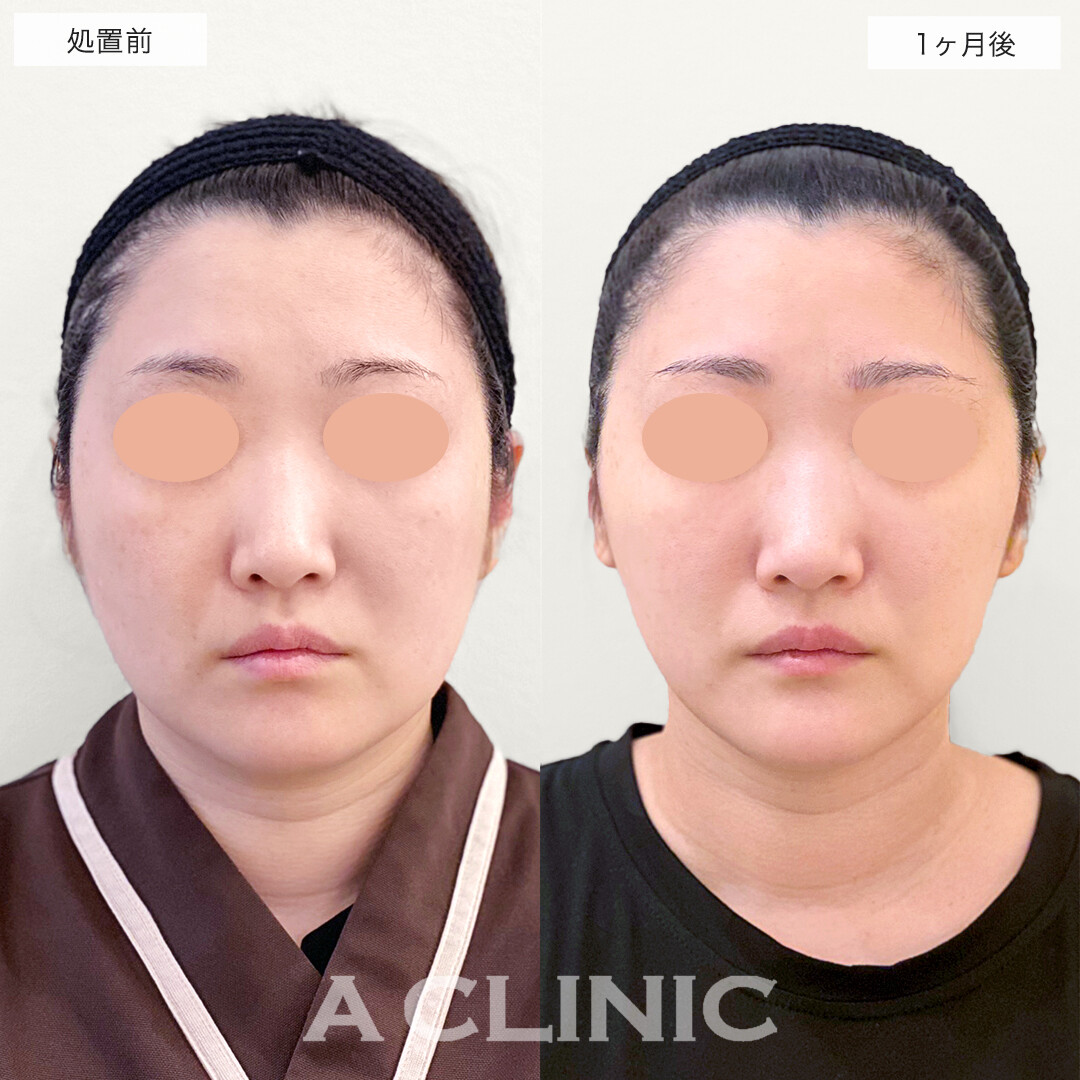 1day小顔脂肪吸引とナゾラビアルファット除去術で、全体的なたるみ脂肪とそれに伴うほうれい線もWでケア！処置前と1ヶ月後の症例です(40代女性)