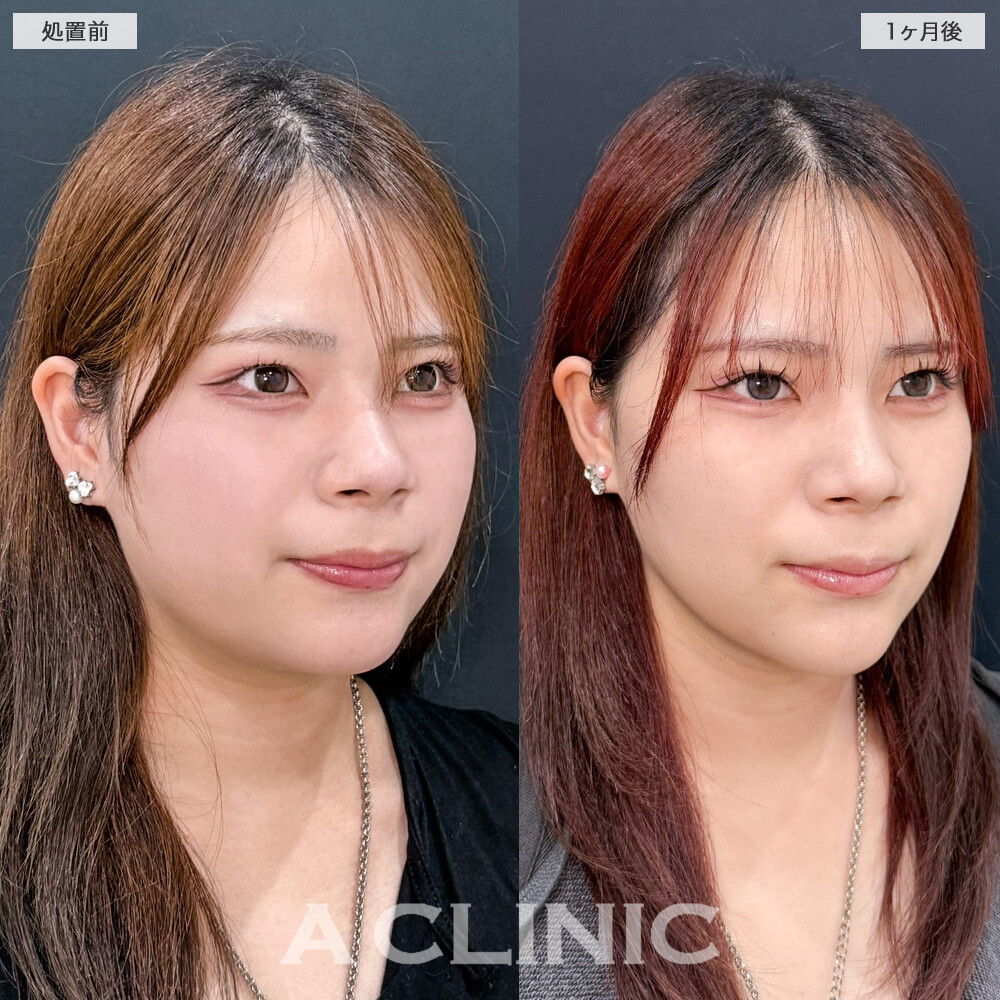 1day小顔脂肪吸引で抱えていた二重顎がスッキリ解消されました！こちら処置前と1ヶ月後の症例です(20代女性)