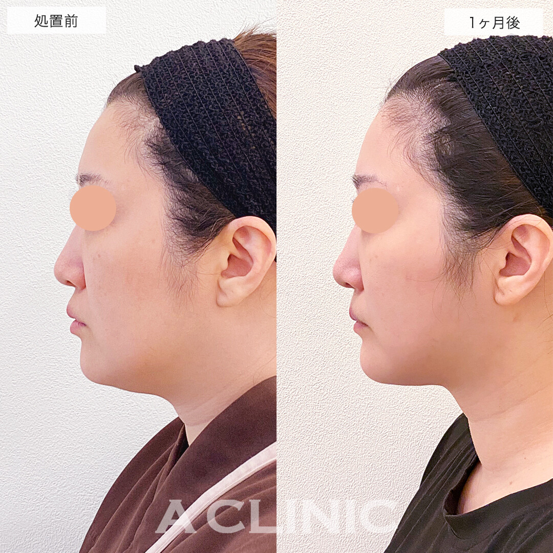 1day小顔脂肪吸引とナゾラビアルファット除去術で、全体的なたるみ脂肪とそれに伴うほうれい線もWでケア！処置前と1ヶ月後の症例です(40代女性)