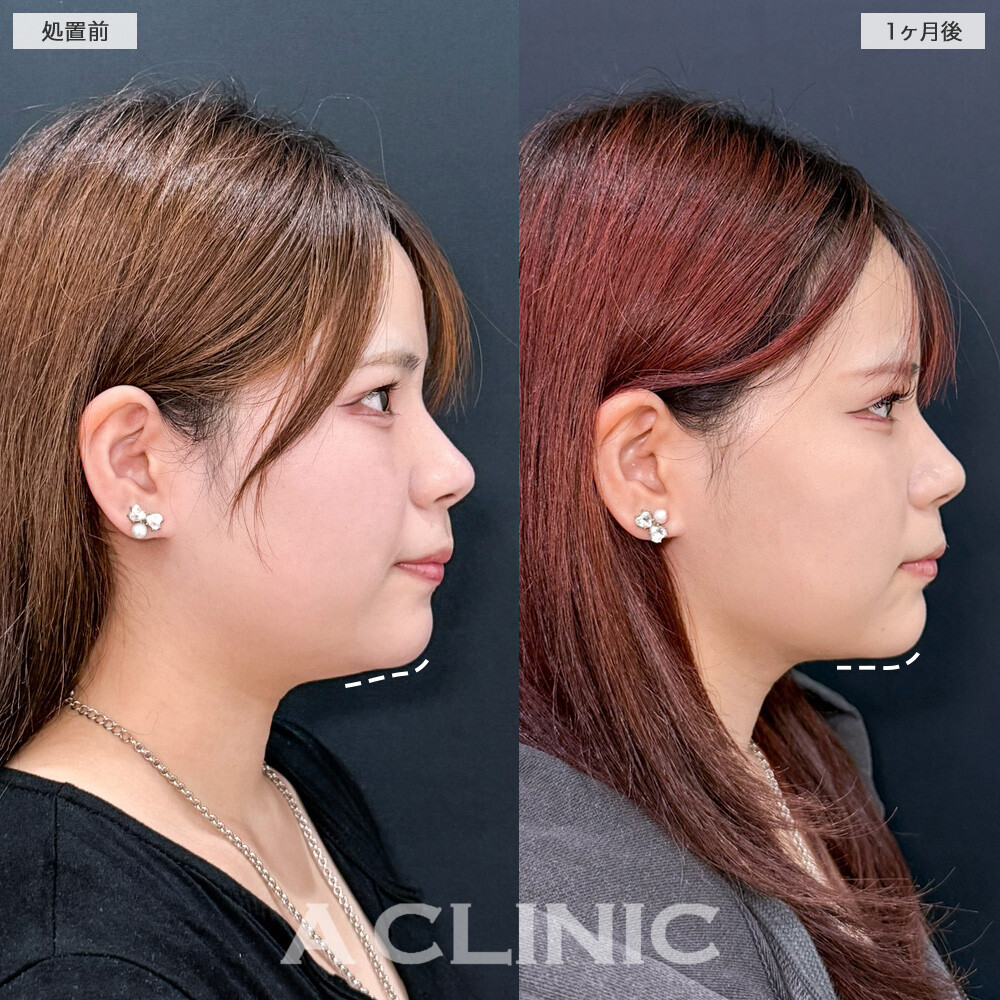 1day小顔脂肪吸引で抱えていた二重顎がスッキリ解消されました！こちら処置前と1ヶ月後の症例です(20代女性)