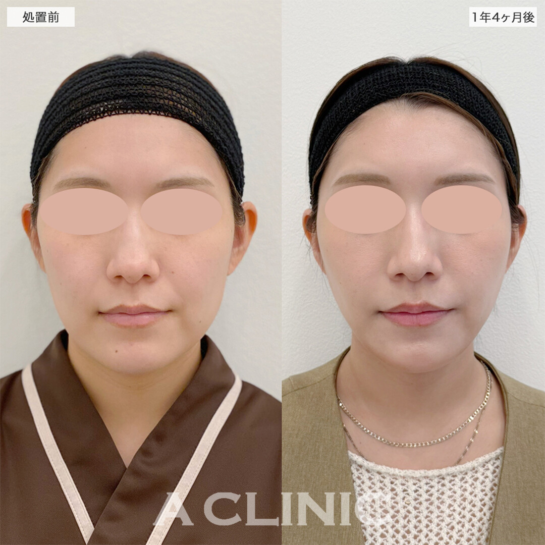 1day小顔脂肪吸引は1年経過しても小顔をキープできます！こちら処置前と1年4ヶ月後の症例です(20代女性)