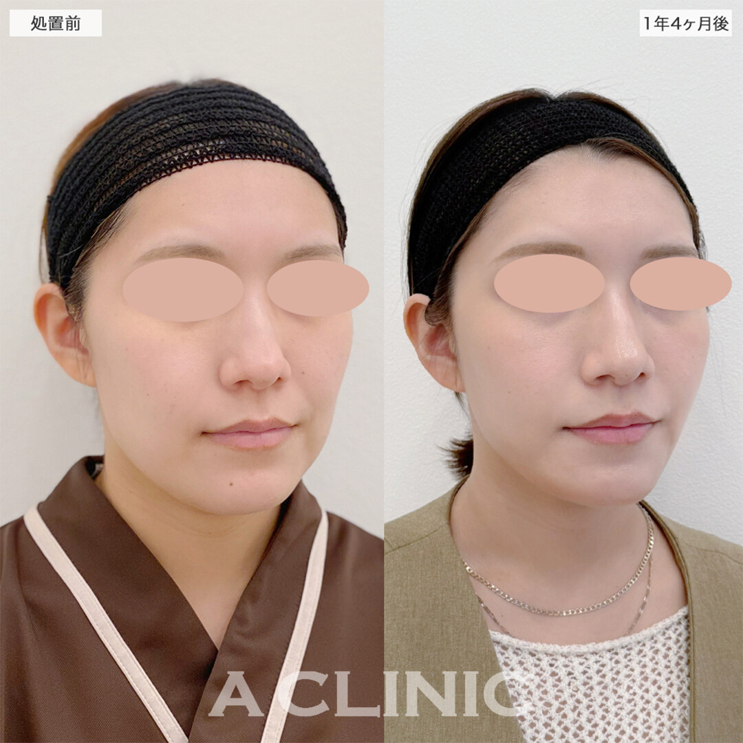1day小顔脂肪吸引は1年経過しても小顔をキープできます！こちら処置前と1年4ヶ月後の症例です(20代女性)