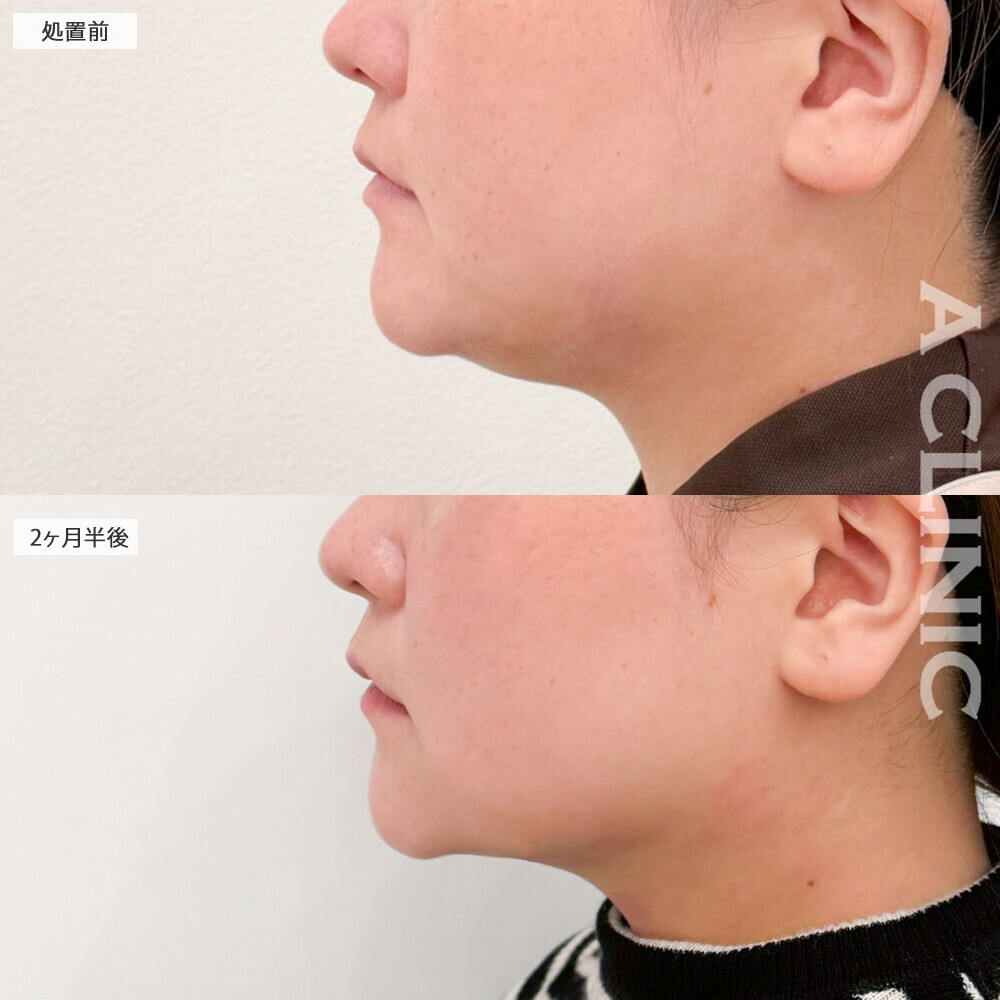 1day小顔脂肪吸引で二重あご改善!こちら処置前から2ヶ月半後の症例です(20代女性)