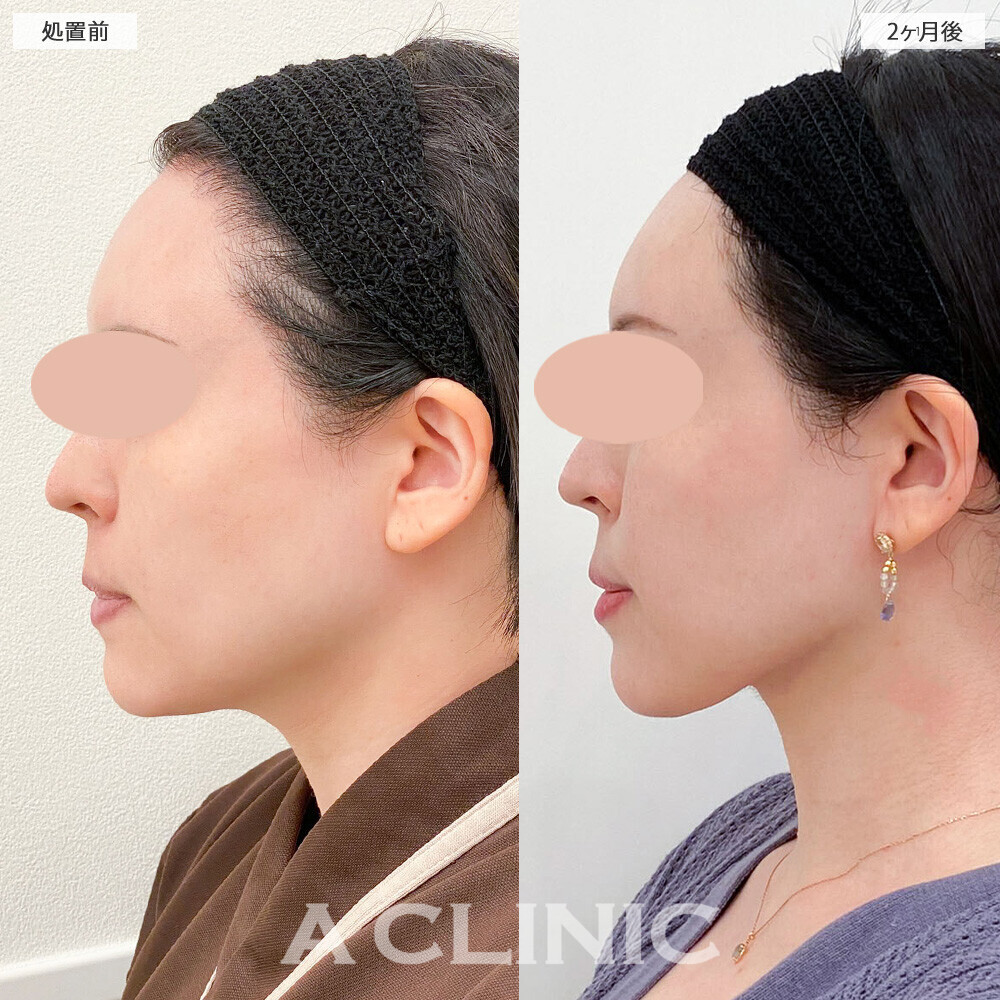 1day小顔脂肪吸引と小顔エラボトックスでスッキリ輪郭が整いました！こちら処置前から2ヶ月後の症例です(30代女性)