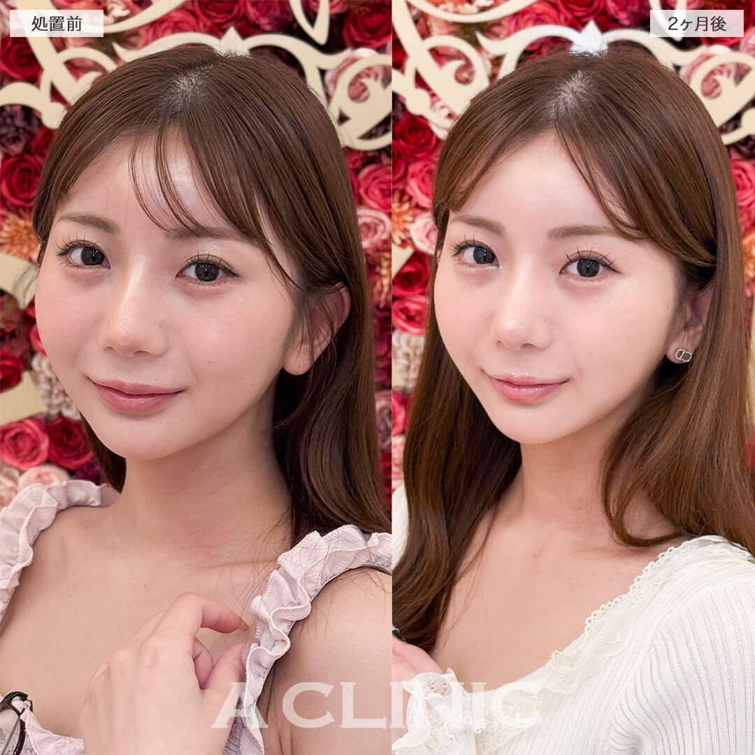 1day小顔脂肪吸引とバッカルファット除去術で元々の骨格を活かした小顔に！処置前と2ヶ月後の症例です(20代女性)