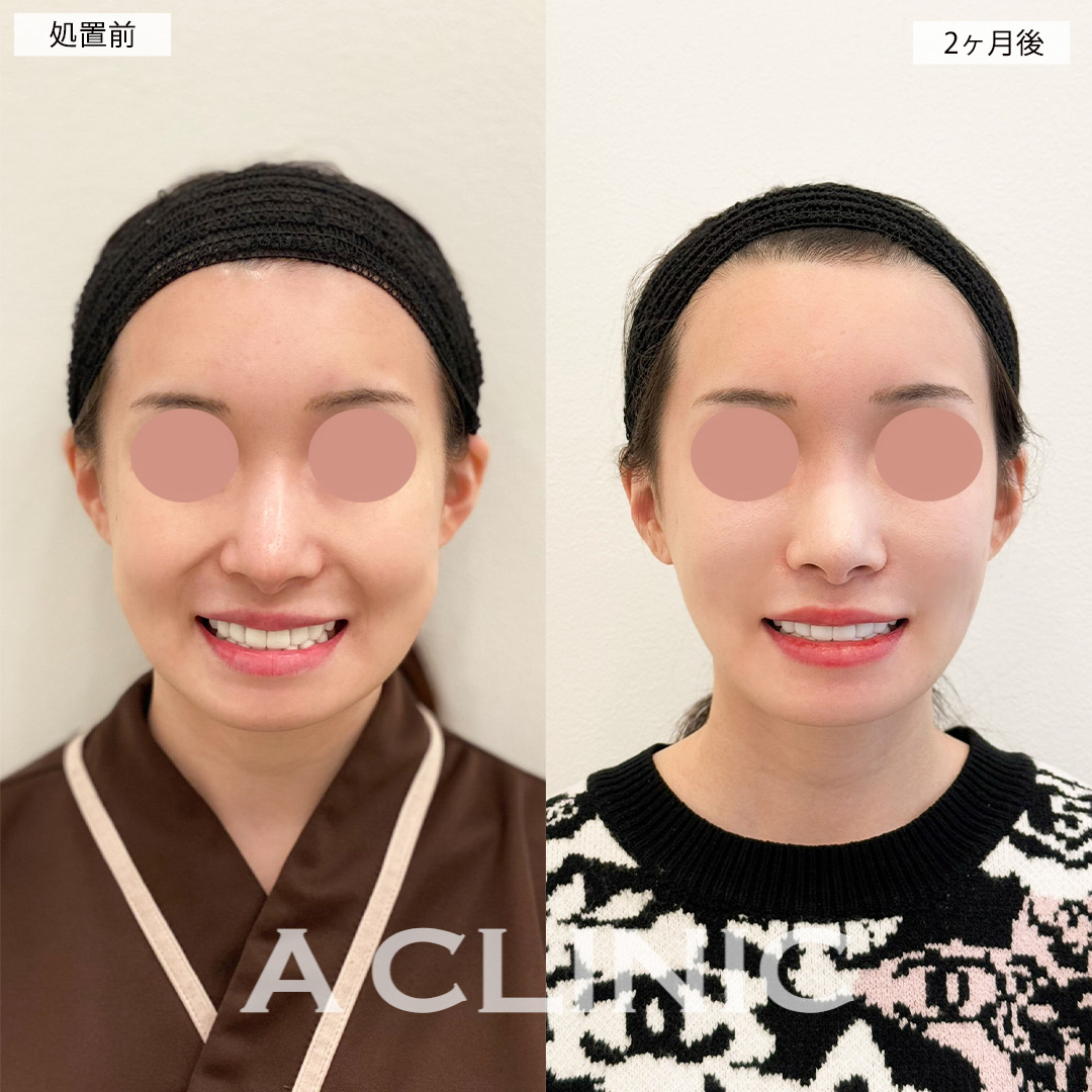 1day小顔脂肪吸引とバッカルファット除去術で笑った時の頬の張りが改善されました！こちら処置前と2ヶ月後の症例です(20代女性)