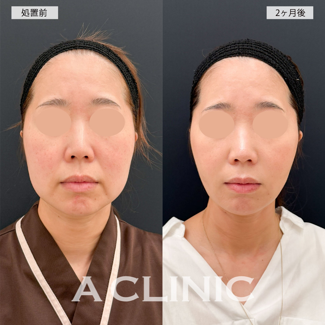 1day小顔脂肪吸引でお顔の大きさが一回り以上小さくなりました!こちら処置前と2ヶ月後の症例です(40代女性)