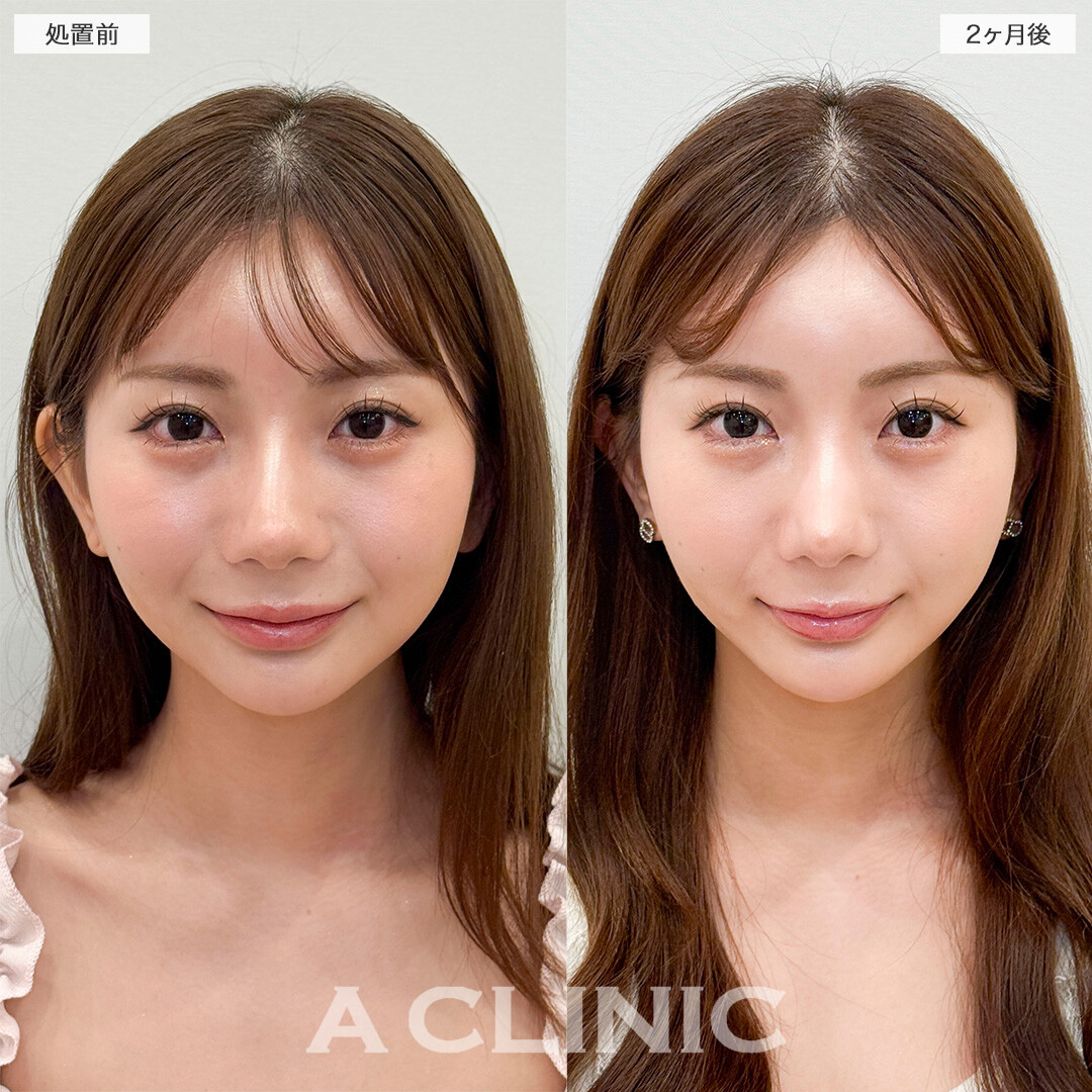 1day小顔脂肪吸引とバッカルファット除去術で元々の骨格を活かした小顔に！処置前と2ヶ月後の症例です(20代女性)