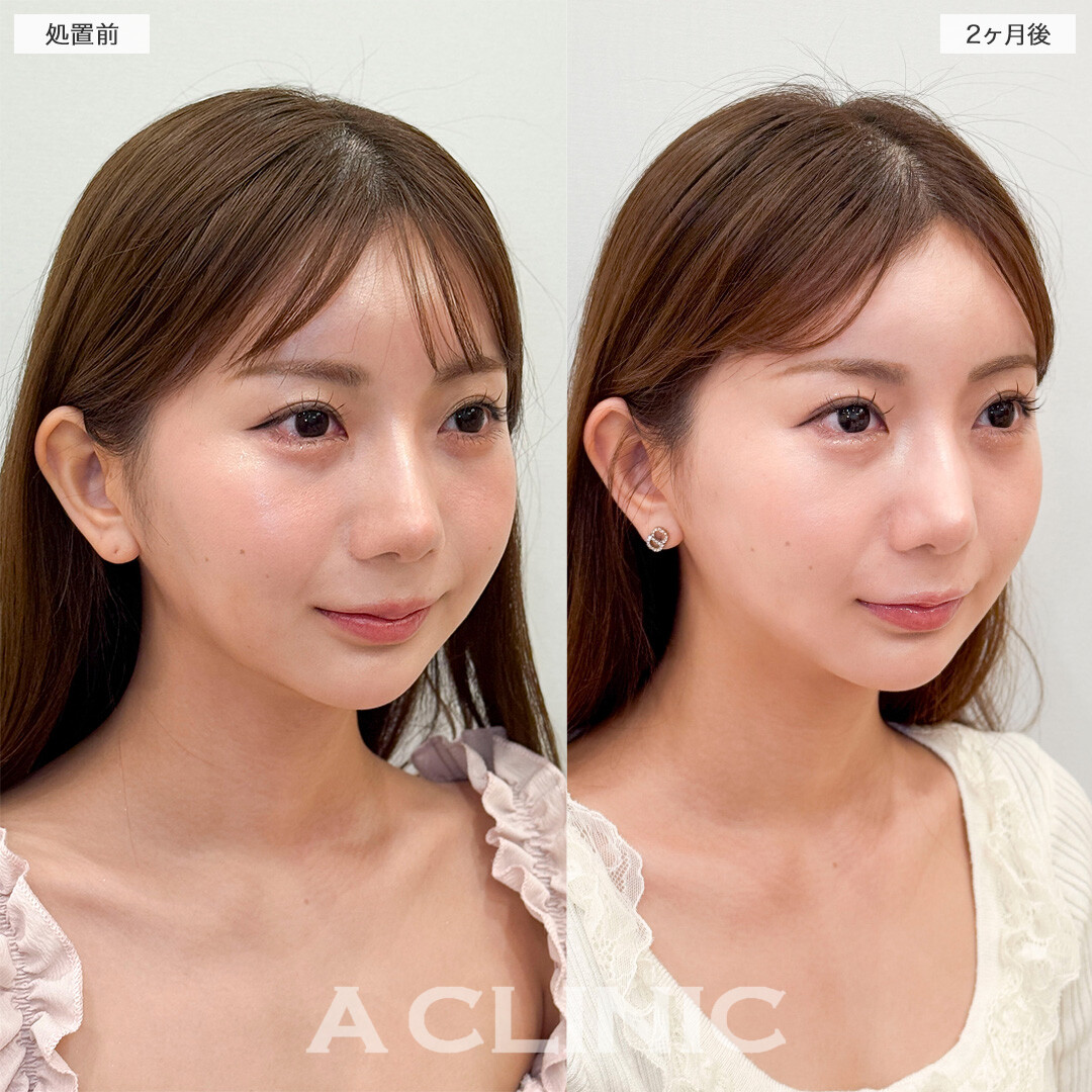 1day小顔脂肪吸引とバッカルファット除去術で元々の骨格を活かした小顔に！処置前と2ヶ月後の症例です(20代女性)