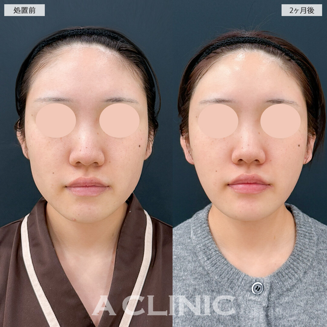 1day小顔脂肪吸引と小顔エラボトックスで顔全体のバランスが良くなりました！処置前と2ヶ月後の症例です(20代女性)