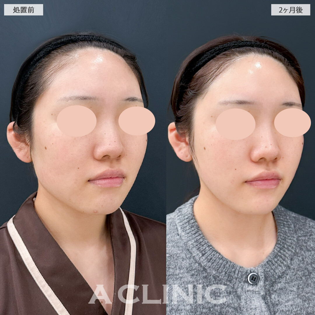 1day小顔脂肪吸引と小顔エラボトックスで顔全体のバランスが良くなりました！処置前と2ヶ月後の症例です(20代女性)