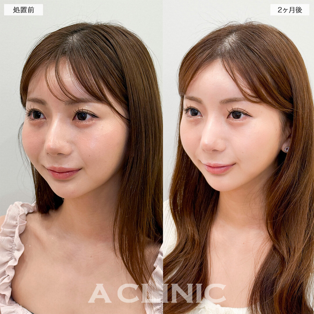 1day小顔脂肪吸引とバッカルファット除去術で元々の骨格を活かした小顔に！処置前と2ヶ月後の症例です(20代女性)