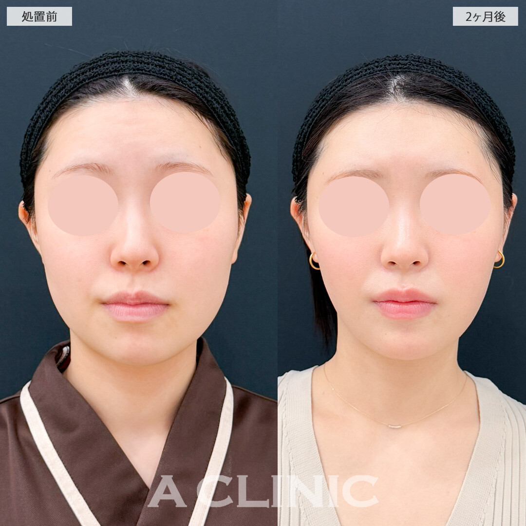 1day小顔脂肪吸引とあごへのヒアルロン酸注入で小顔になれるだけでなくフェイスラインも理想の形になりました！処置前と2ヶ月後の症例です(20代女性)
