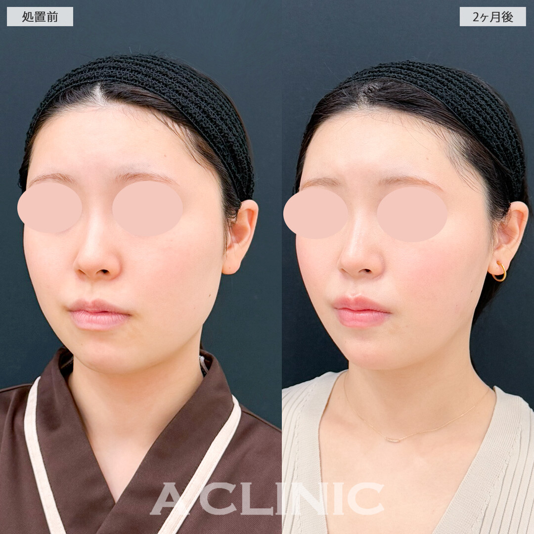 1day小顔脂肪吸引とあごへのヒアルロン酸注入で小顔になれるだけでなくフェイスラインも理想の形になりました！処置前と2ヶ月後の症例です(20代女性)