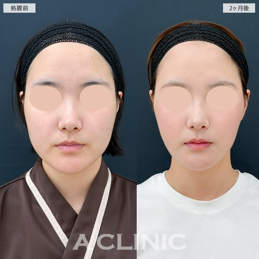 1day小顔脂肪吸引と小顔エラボトックスでダイエットだけでは不可能なほどのスッキリ感！処置前と2ヶ月後の症例です(20代女性)