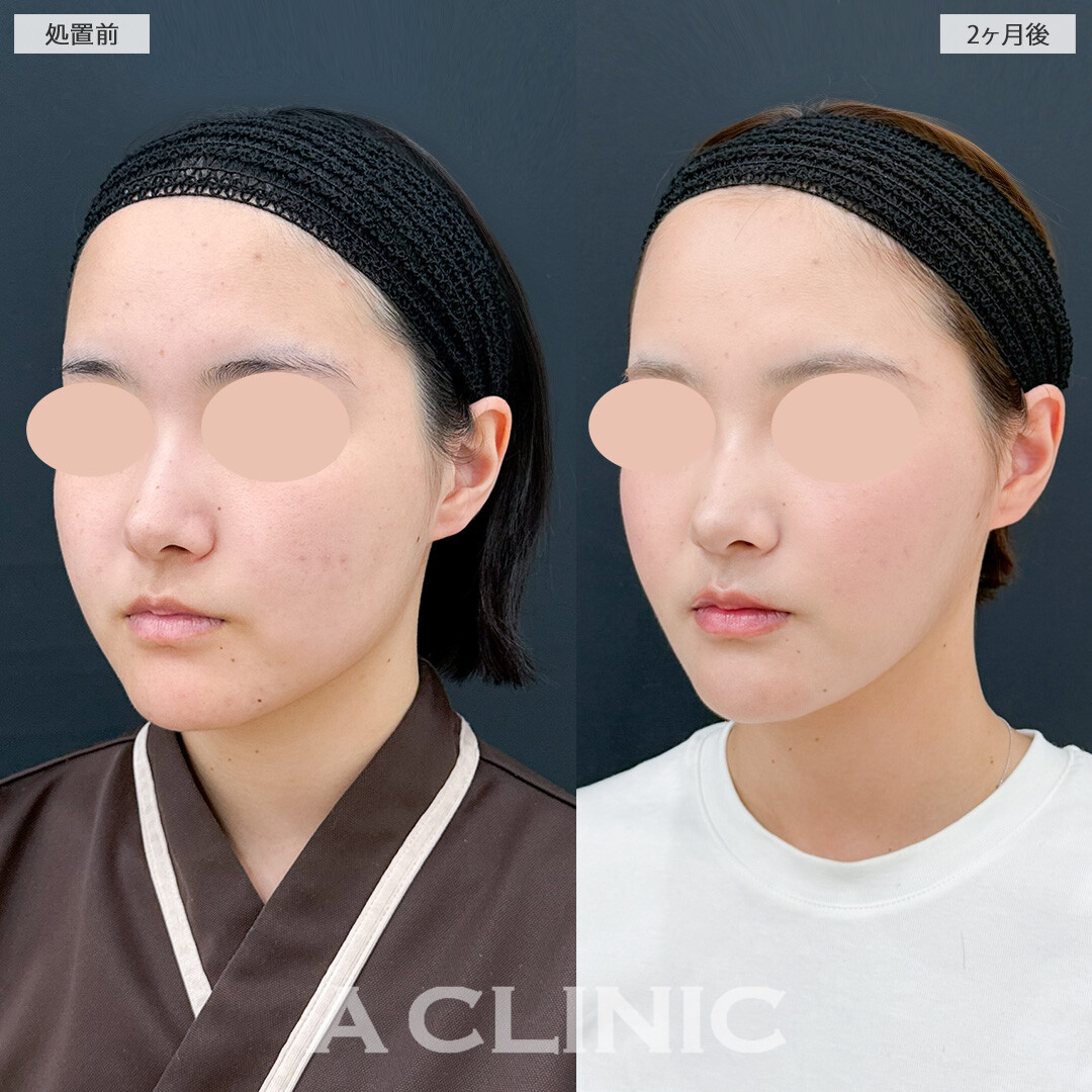 1day小顔脂肪吸引と小顔エラボトックスでダイエットだけでは不可能なほどのスッキリ感！処置前と2ヶ月後の症例です(20代女性)