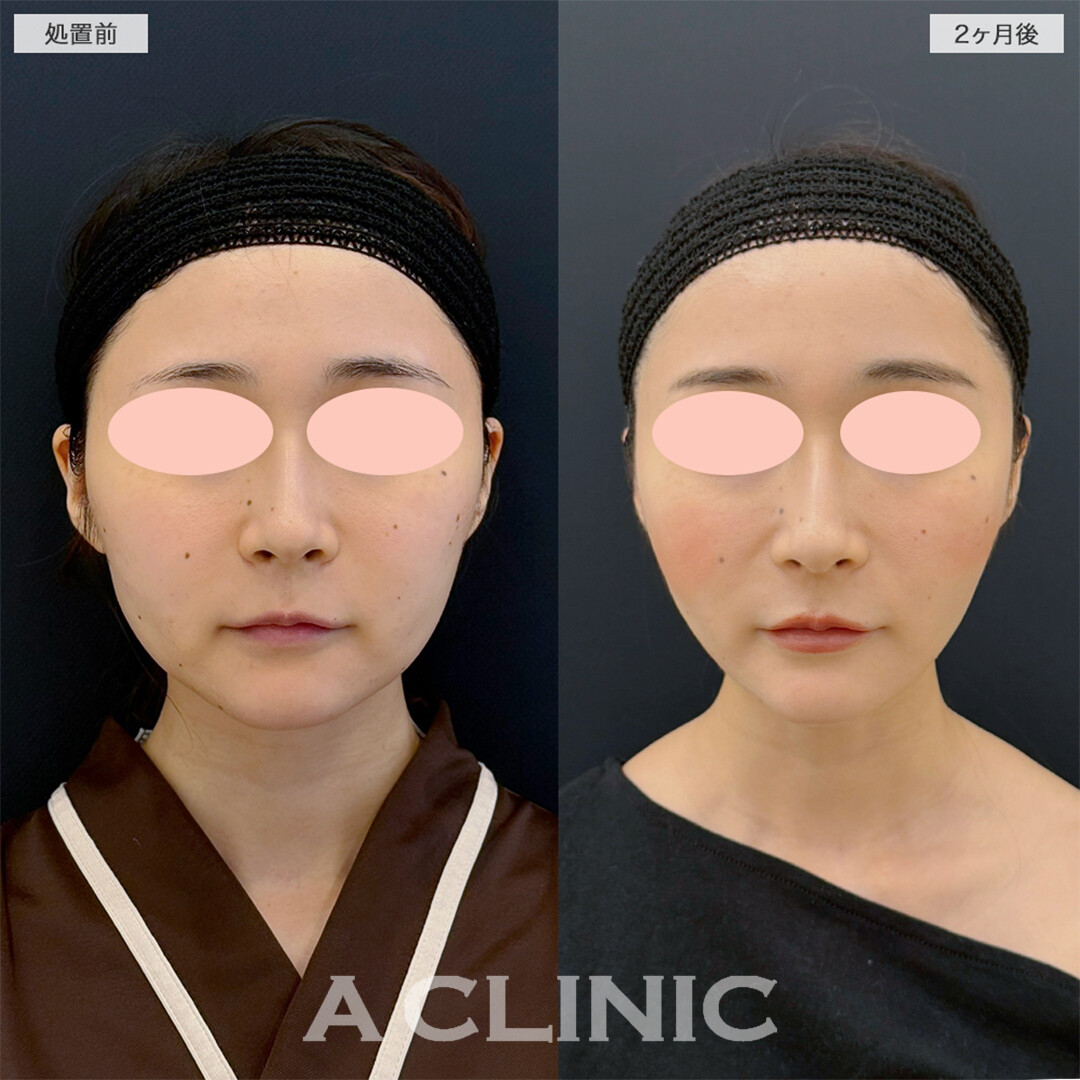 1day小顔脂肪吸引とナゾラビアルファット除去術でお顔の脂肪撃退！こちら処置前と2ヶ月後の症例です(20代女性)