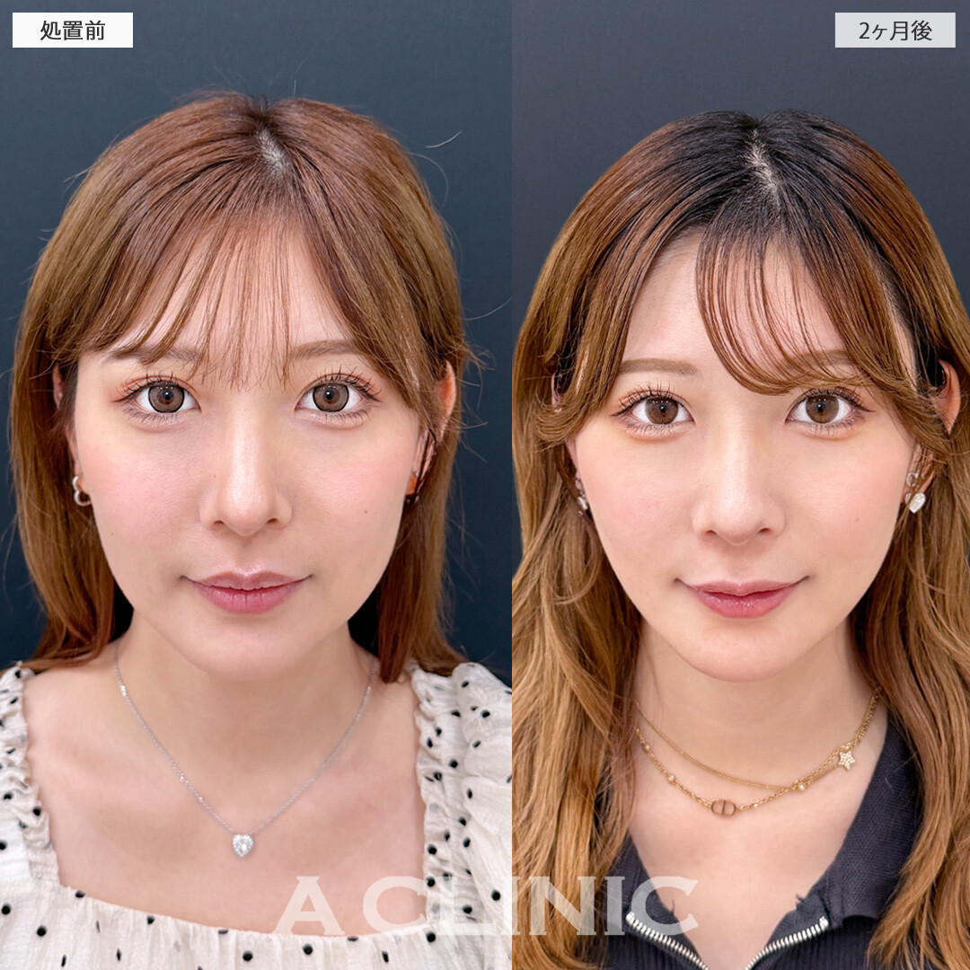 お顔の脂肪吸引で輪郭が整い加工後のようなフェイスラインに！1day小顔脂肪吸引の処置前と2ヶ月後の症例です(30代女性)