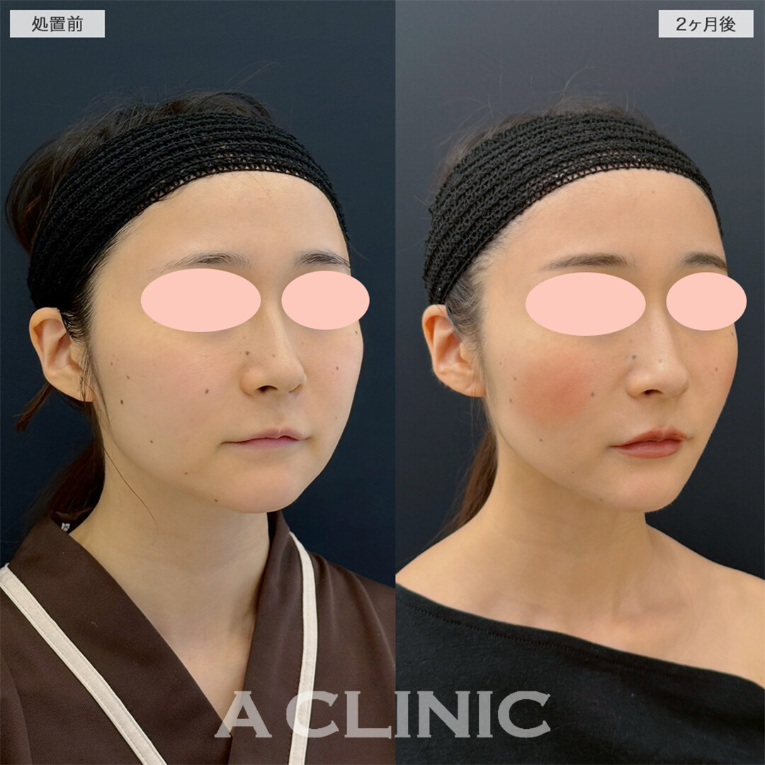 1day小顔脂肪吸引とナゾラビアルファット除去術でお顔の脂肪撃退！こちら処置前と2ヶ月後の症例です(20代女性)