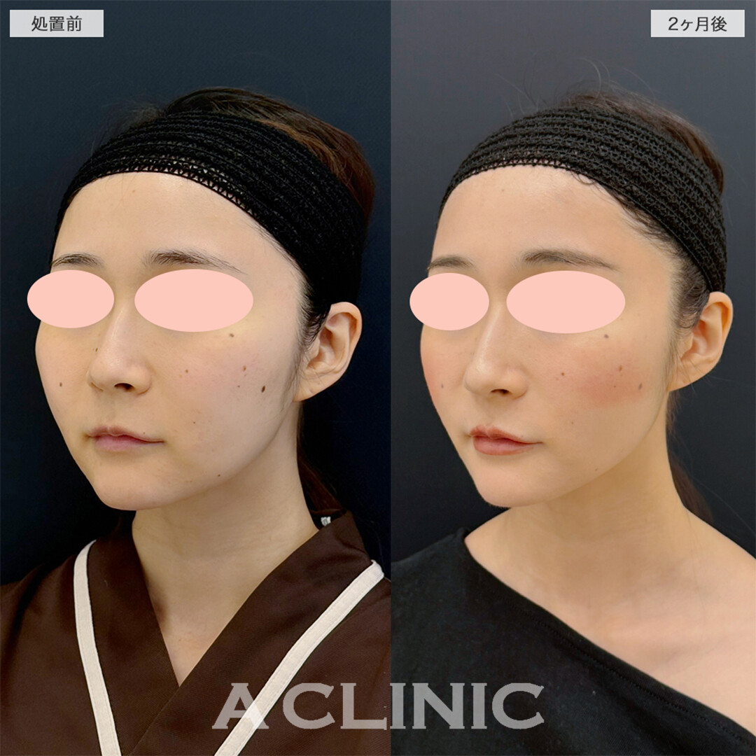 1day小顔脂肪吸引とナゾラビアルファット除去術でお顔の脂肪撃退！こちら処置前と2ヶ月後の症例です(20代女性)