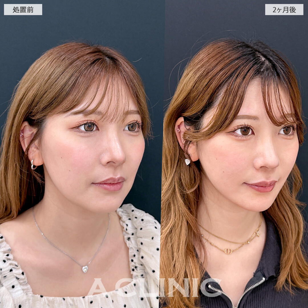 お顔の脂肪吸引で輪郭が整い加工後のようなフェイスラインに！1day小顔脂肪吸引の処置前と2ヶ月後の症例です(30代女性)