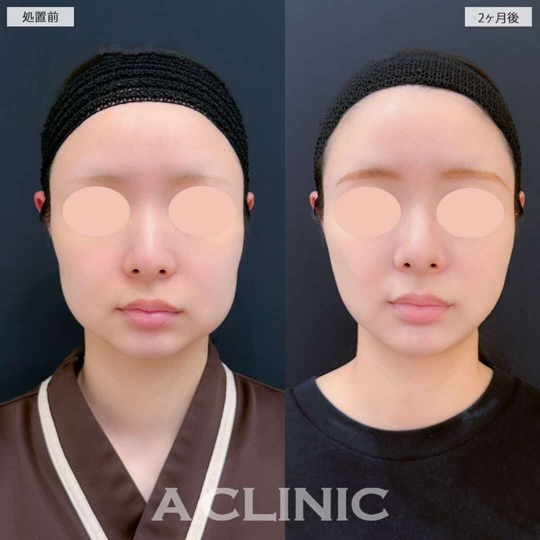 1day小顔脂肪吸引とバッカルファット除去術と小顔エラボトックスで下膨れが解消され輪郭がシュッとしました！こちら処置前と2ヶ月後の症例です(20代女性)