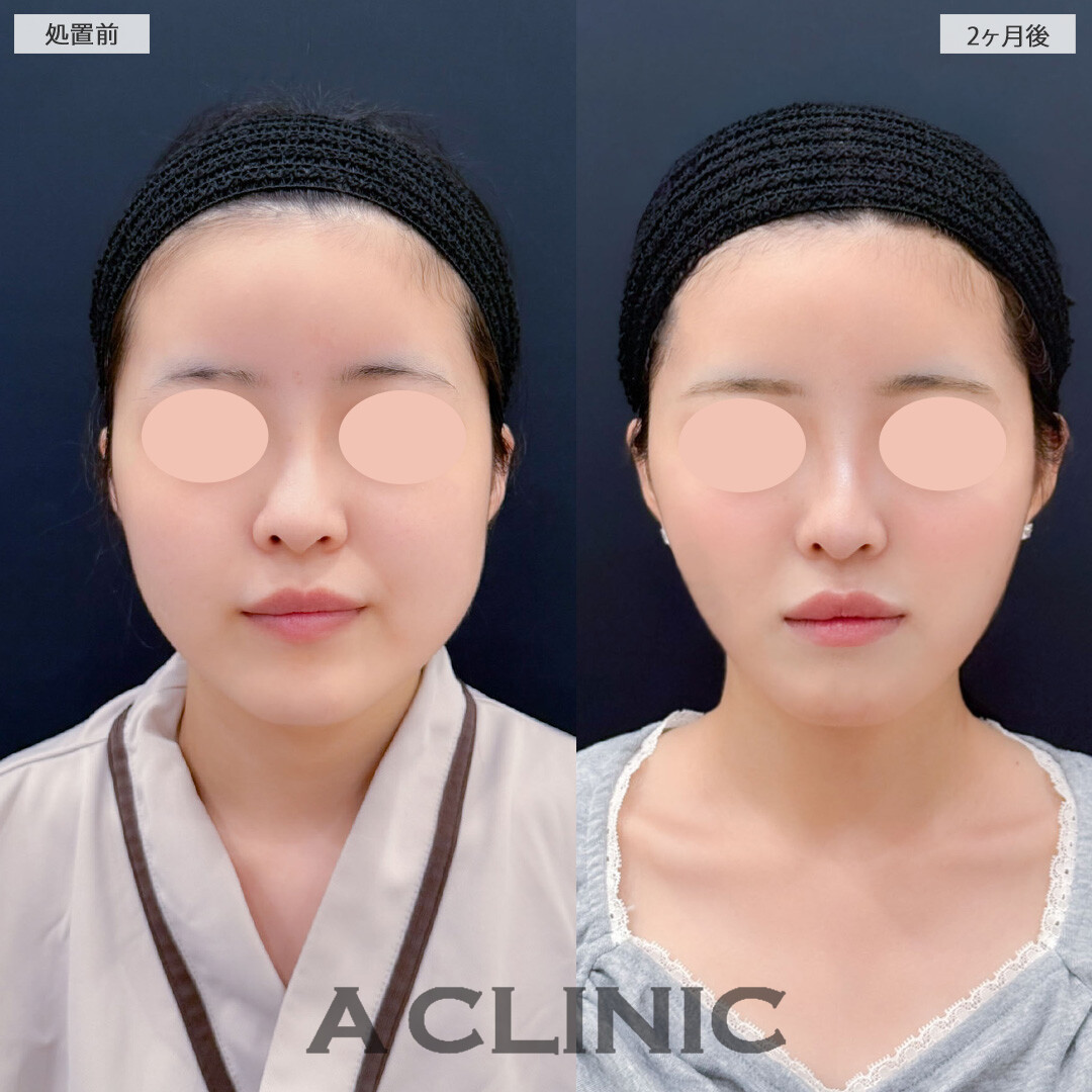 1day小顔脂肪吸引と小顔エラボトックスでナチュラルだけどしっかり小顔になれます！こちら処置前2ヶ月後の症例です(20代女性)