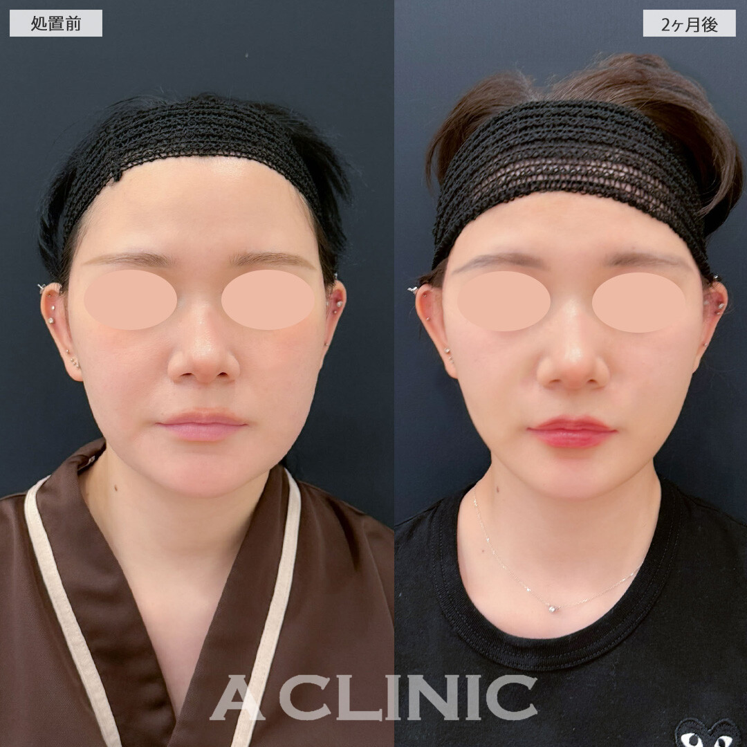 1day小顔脂肪吸引とバッカルファット除去術と小顔エラボトックスで輪郭がシュッとしっかり小顔に！こちら処置前と2ヶ月後の症例です(10代女性)
