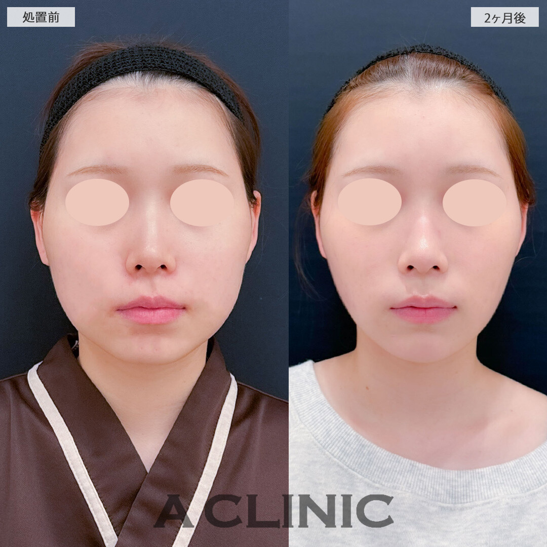 1day小顔脂肪吸引とバッカルファット除去術と小顔エラボトックスで輪郭がスッキリ小顔になりました！こちら処置前と2ヶ月後の症例です(20代女性)