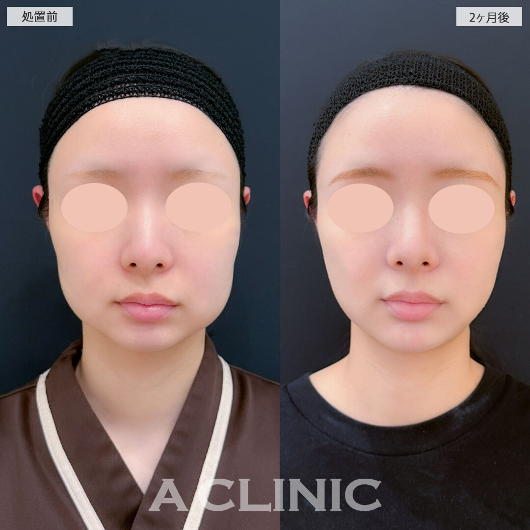 1day小顔脂肪吸引とバッカルファット除去術と小顔エラボトックスで下膨れが解消され輪郭がシュッとしました！こちら処置前と2ヶ月後の症例です(20代女性)
