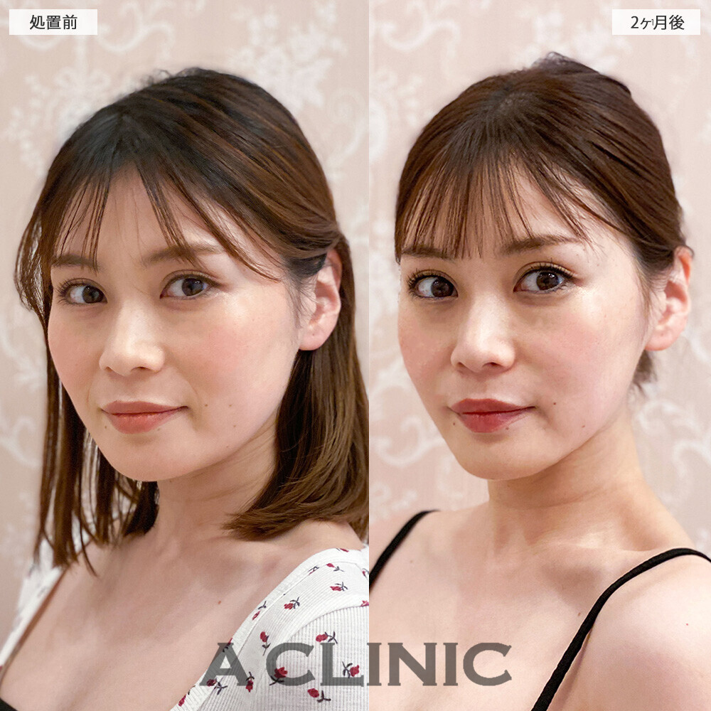 1day小顔脂肪吸引で顔の余白がなくなり若返りました！こちら処置前から2ヶ月後の症例です(30代女性)